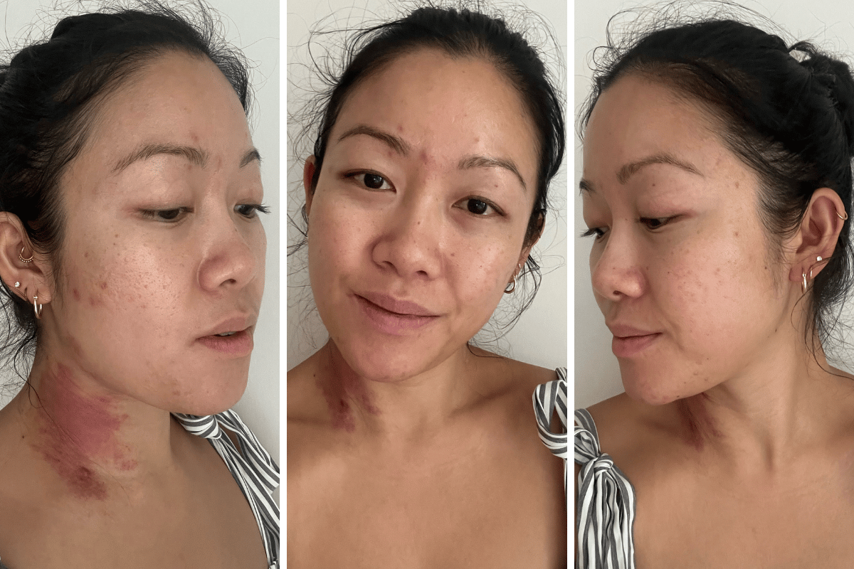 redaktionelle Bevægelig høj Anti dandruff shampoo for acne: Does it really work?