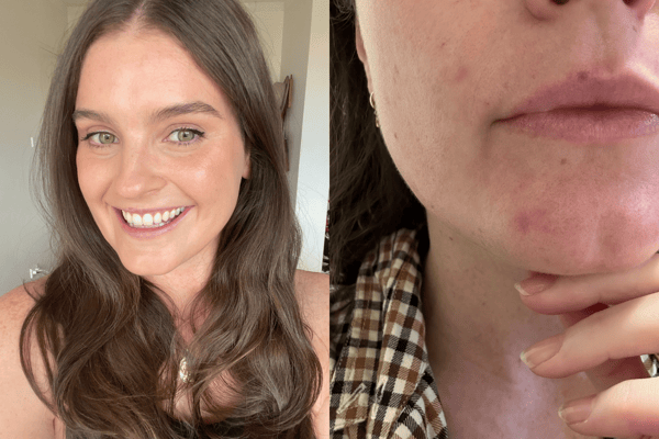 Woman who developed 'catastrophic' acne after quitting the contraceptive  pill goes make-up free to help other sufferers – The Irish Sun