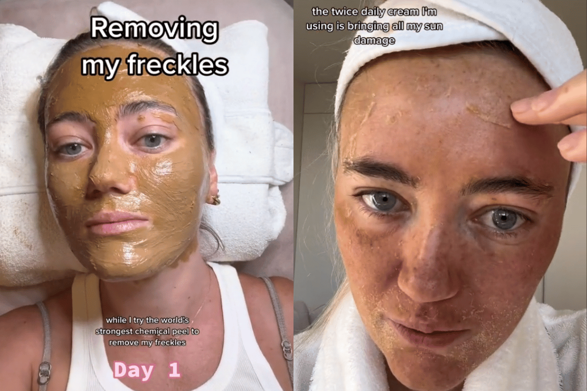 Freckle removal 'I tried a chemical peel to remove them.'