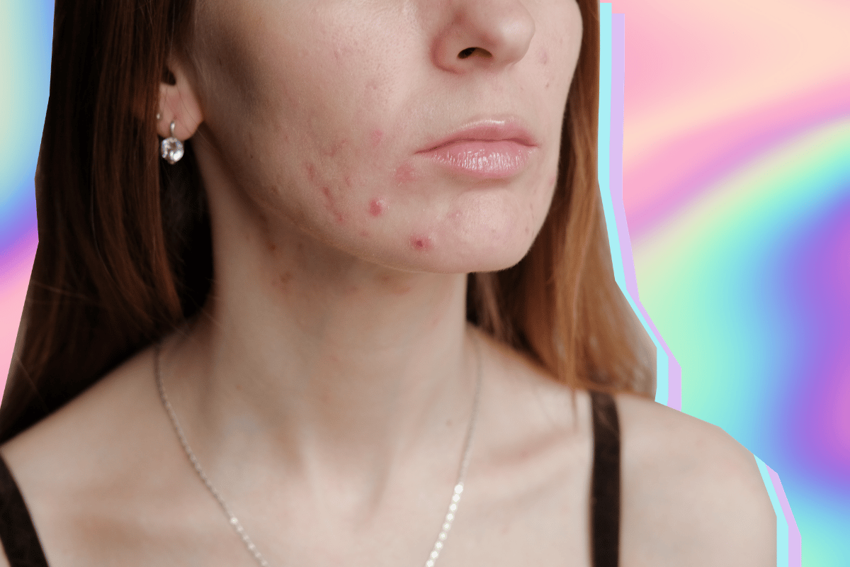 can-dairy-really-cause-acne-we-asked-a-skin-expert