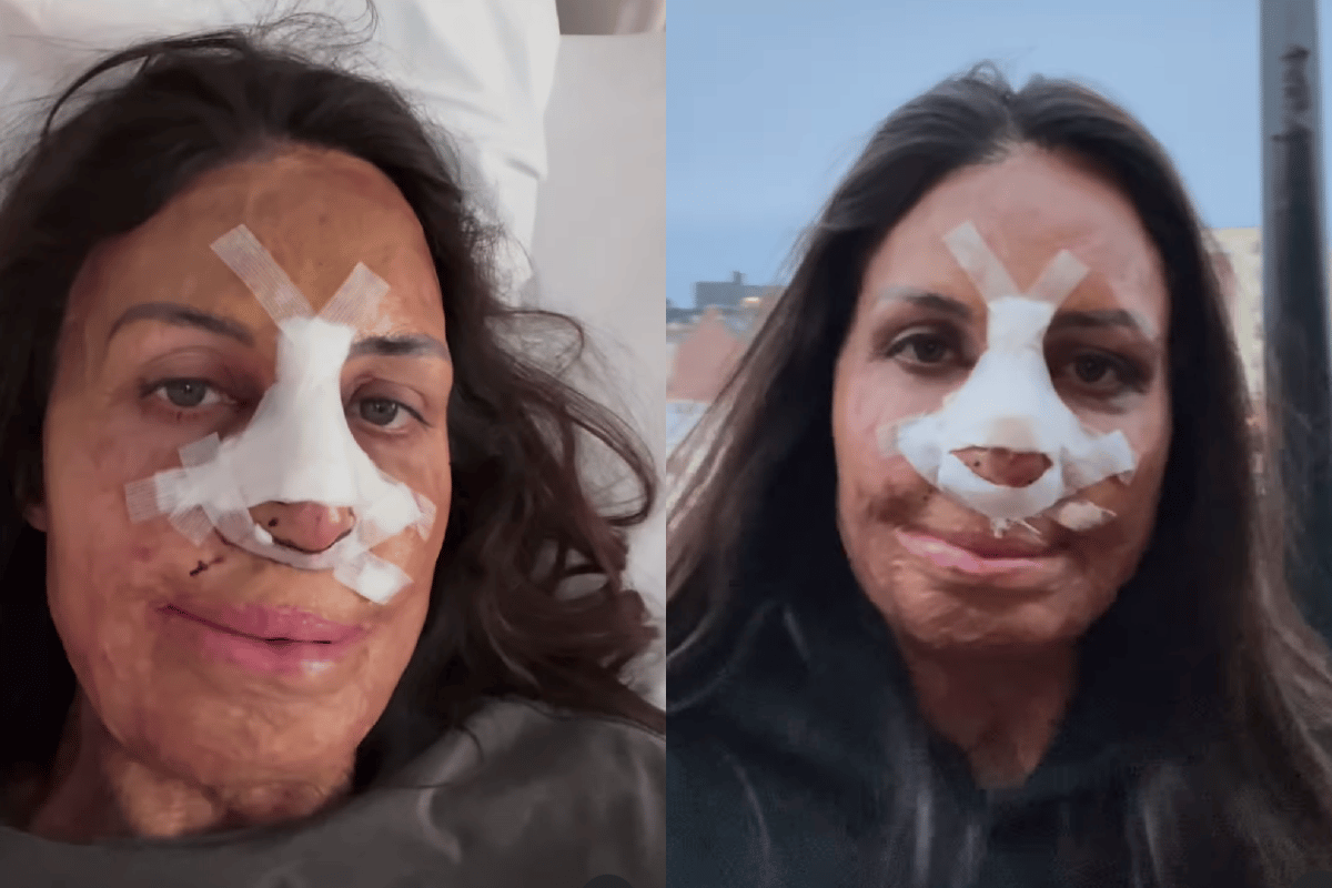 Turia Pitt On Her Partner S Reaction To Her Nose Surgery