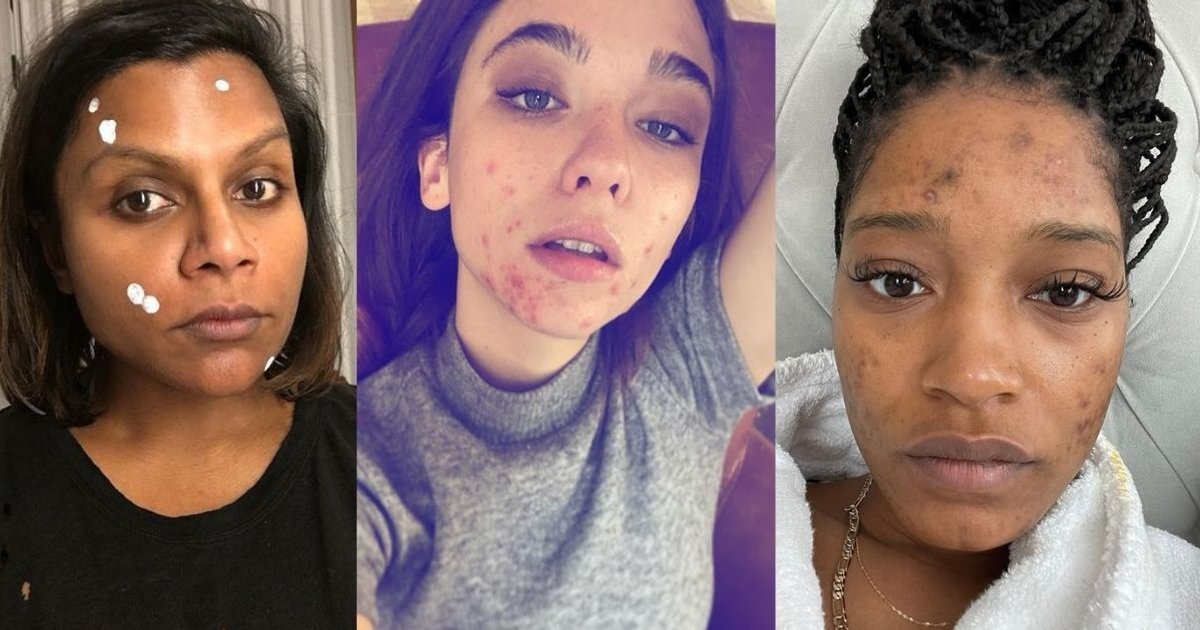 "I didn't want to go to work": 17 celebrities who've openly shared their acne struggles.