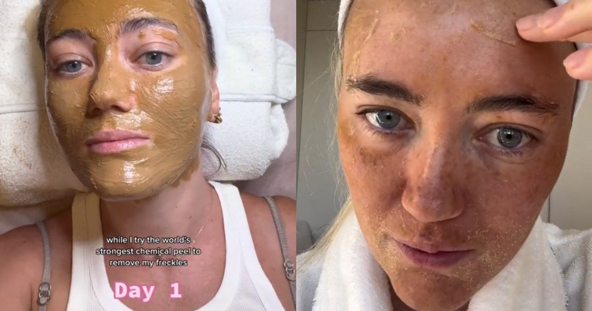Freckle removal: 'I tried a chemical peel to remove them.'