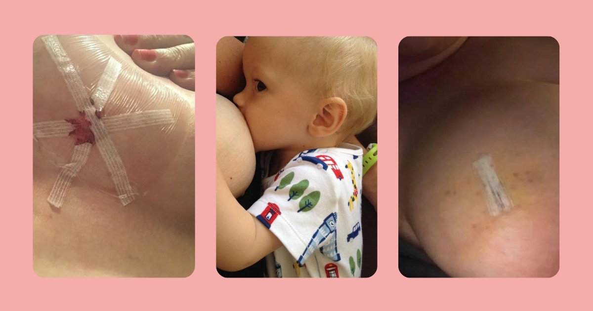 Self breast check: What does a breast lump look like?