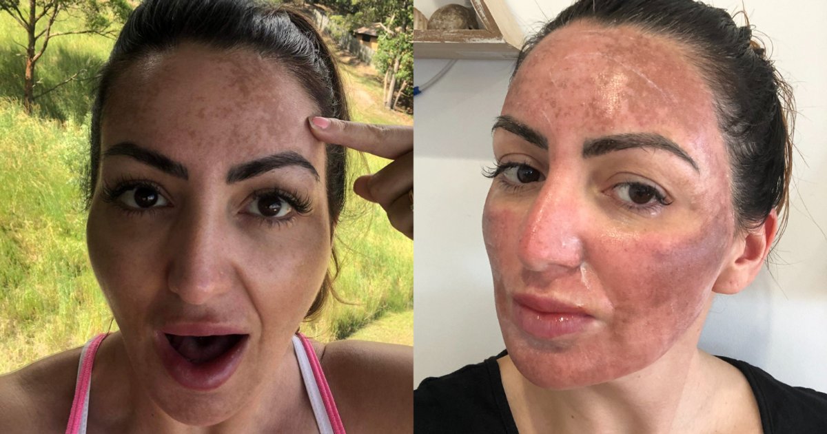 'I tried it all to fix my melasma. Here's what worked.'