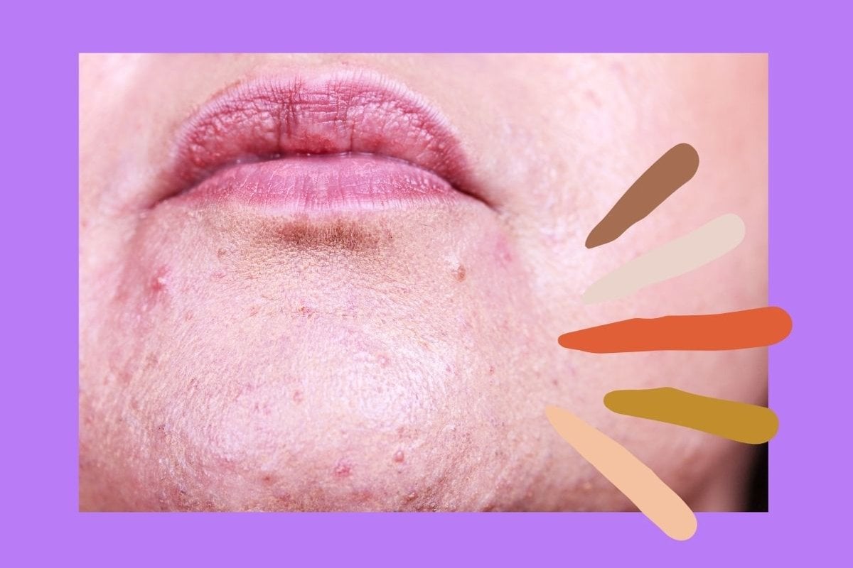 How to treat menopause acne, according to an expert.