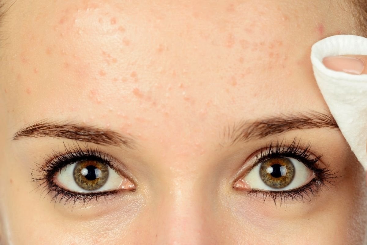 how to get rid of small bumps on your forehead