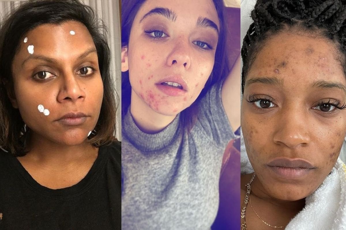 celebrities acne scars