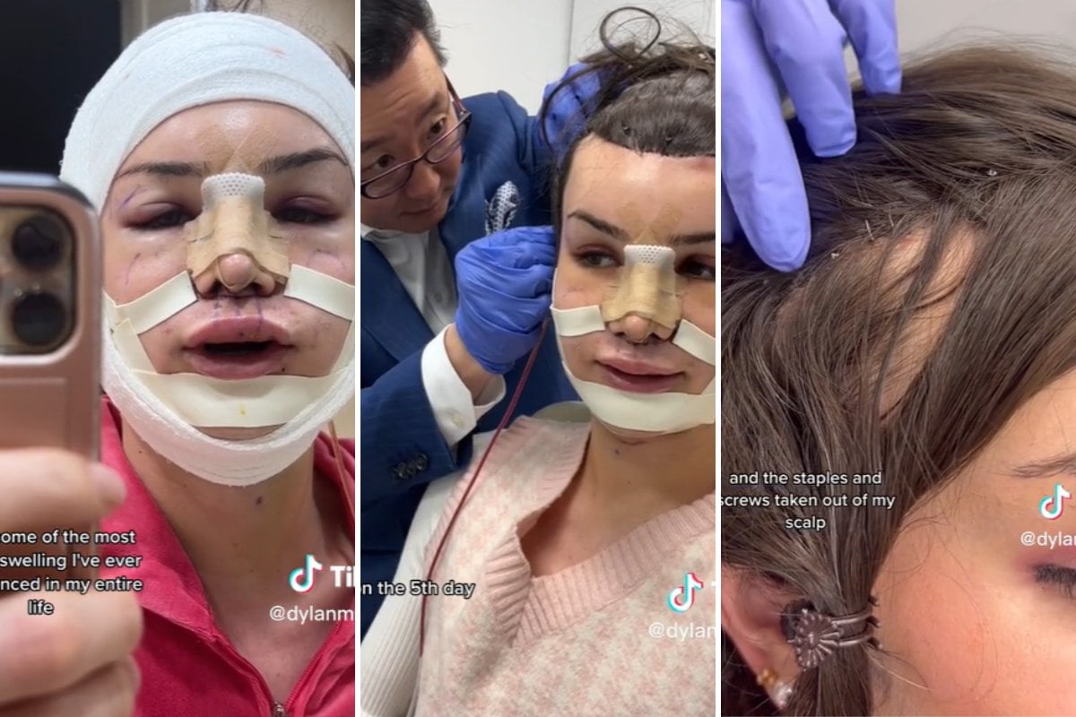 Watch TikToker Dylan Mulvaney's Face Reveal After Surgery