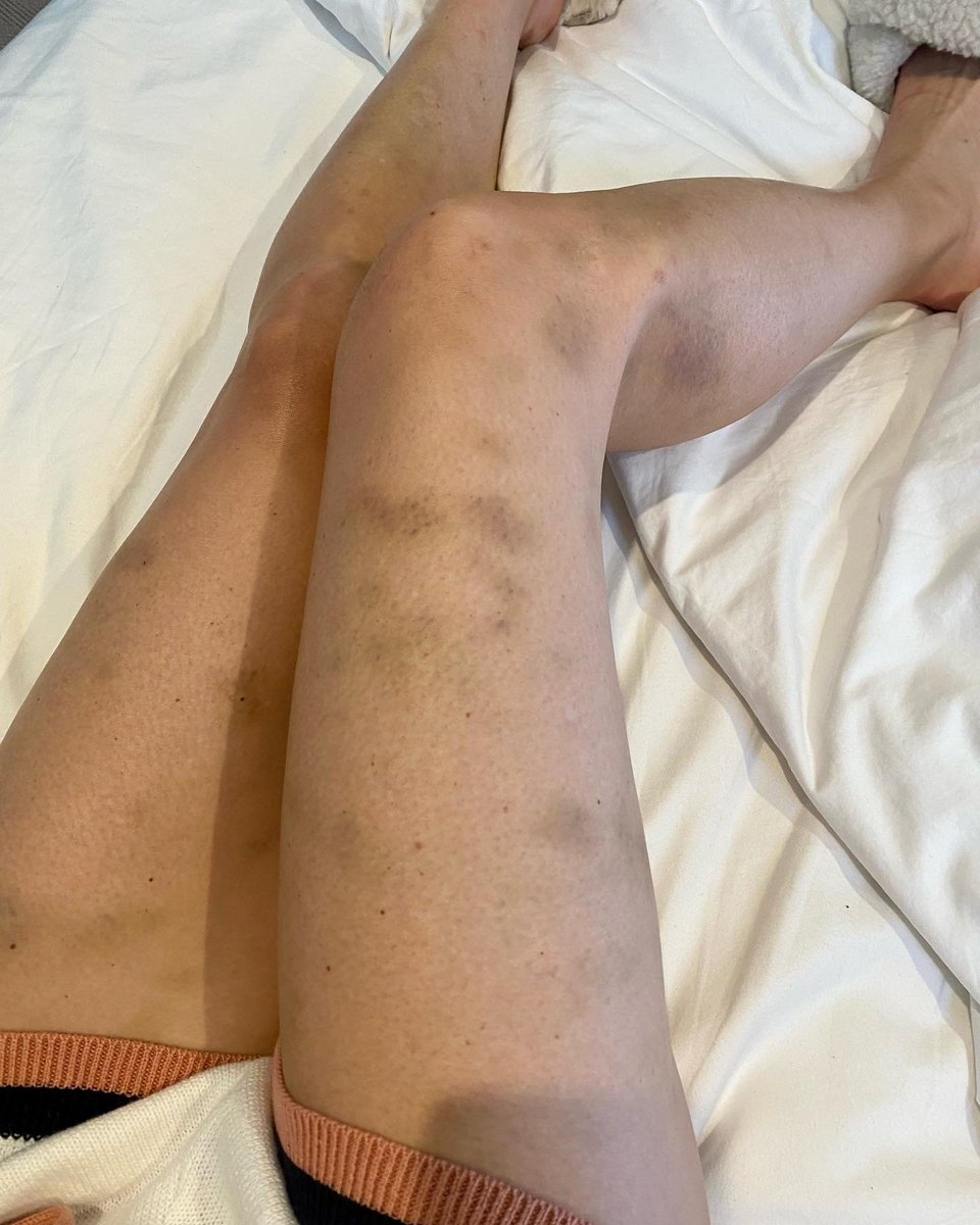 SAS Australia's Simone Holtznagel shows off bruises after show