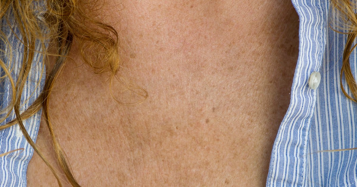 How To Get Rid Of Age Spots According To An Expert