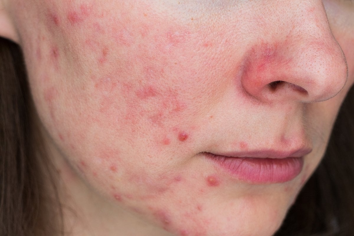 Pityrosporum Folliculitis Cheeks