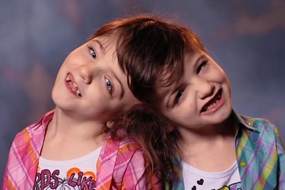 Tatiana and Krista, conjoined twins, inspire everyone with love and