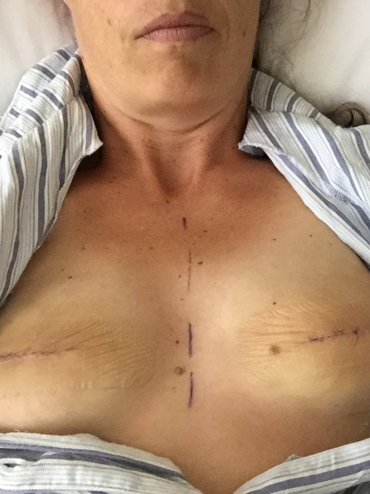 Why I removed my post-mastectomy breast implants.