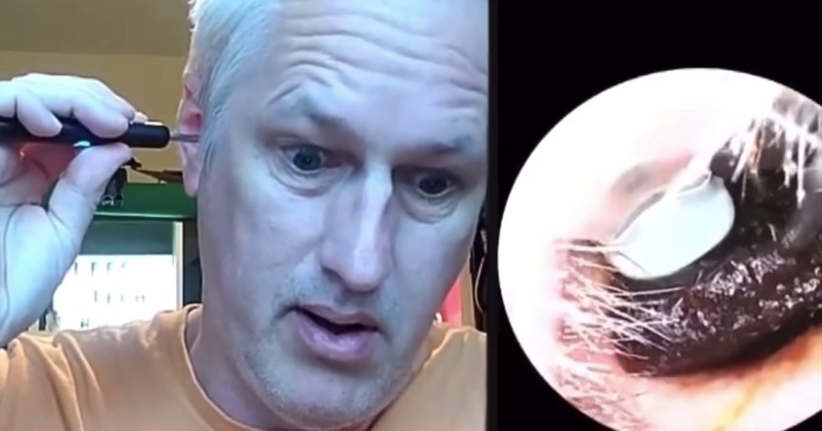 People are filming themselves digging earwax out. It's mesmerising and sickening all at once