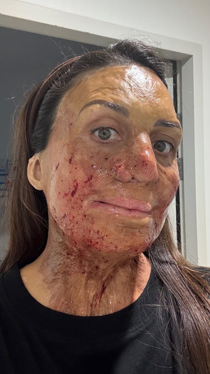 turia pitt skin remodelling surgery