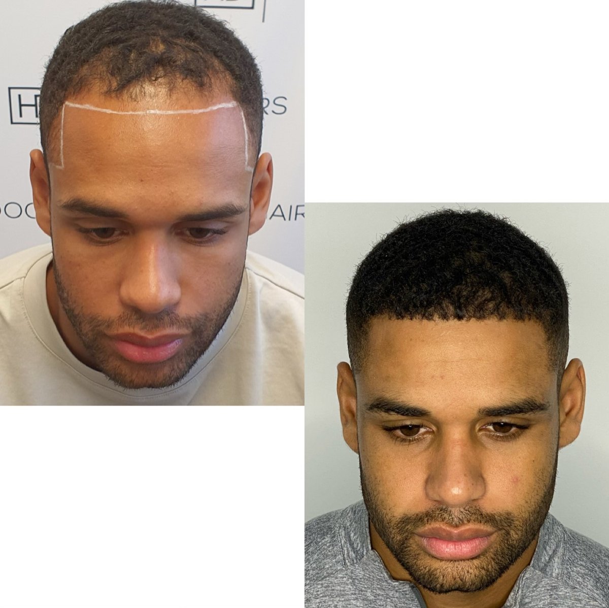 A before and after photo of a male hair transplant procedure, with receding hairline on the left and a fuller hairline on the right, post hair transplant procedure.