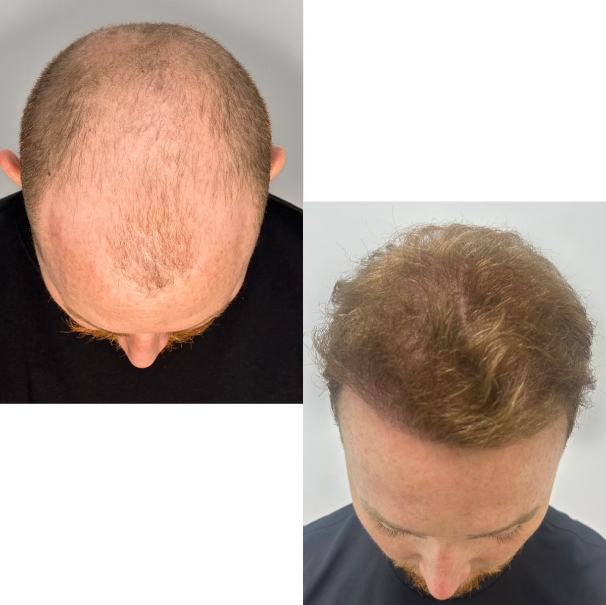 A before and after photo of a male hair transplant procedure, with a balding head on the left and a fuller hairline on the right, post hiar transplant procedure.