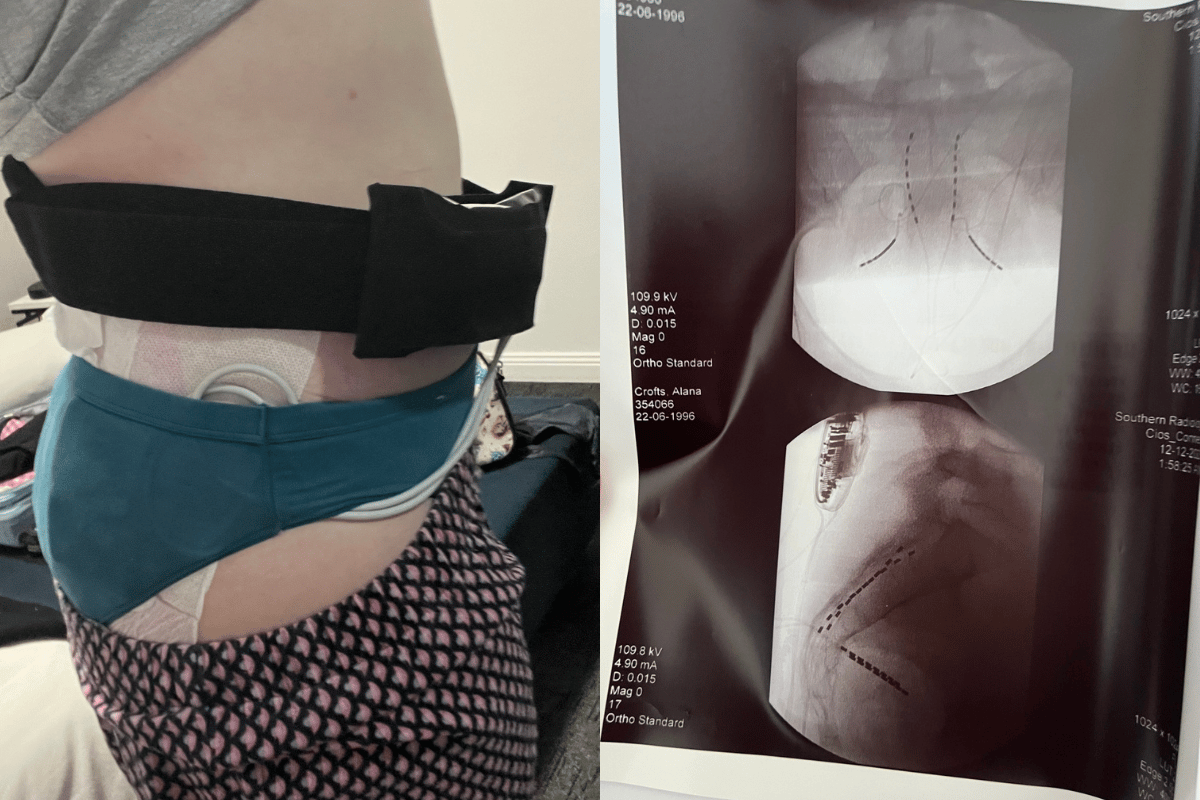 A woman stands side on with her abdomen exposed showing a trial spinal stimulator device in place. An X-ray image shows the device in place.