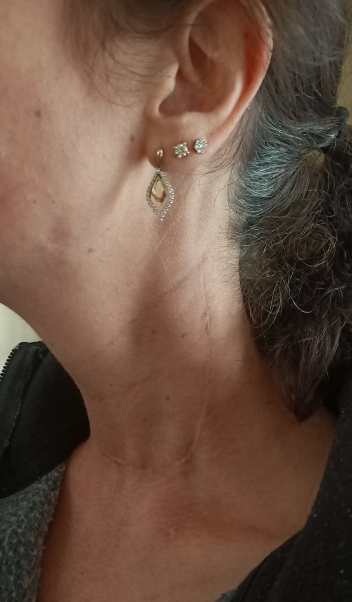 Image of woman's neck with 13cm scar after surgery to remove thyroid cancer.