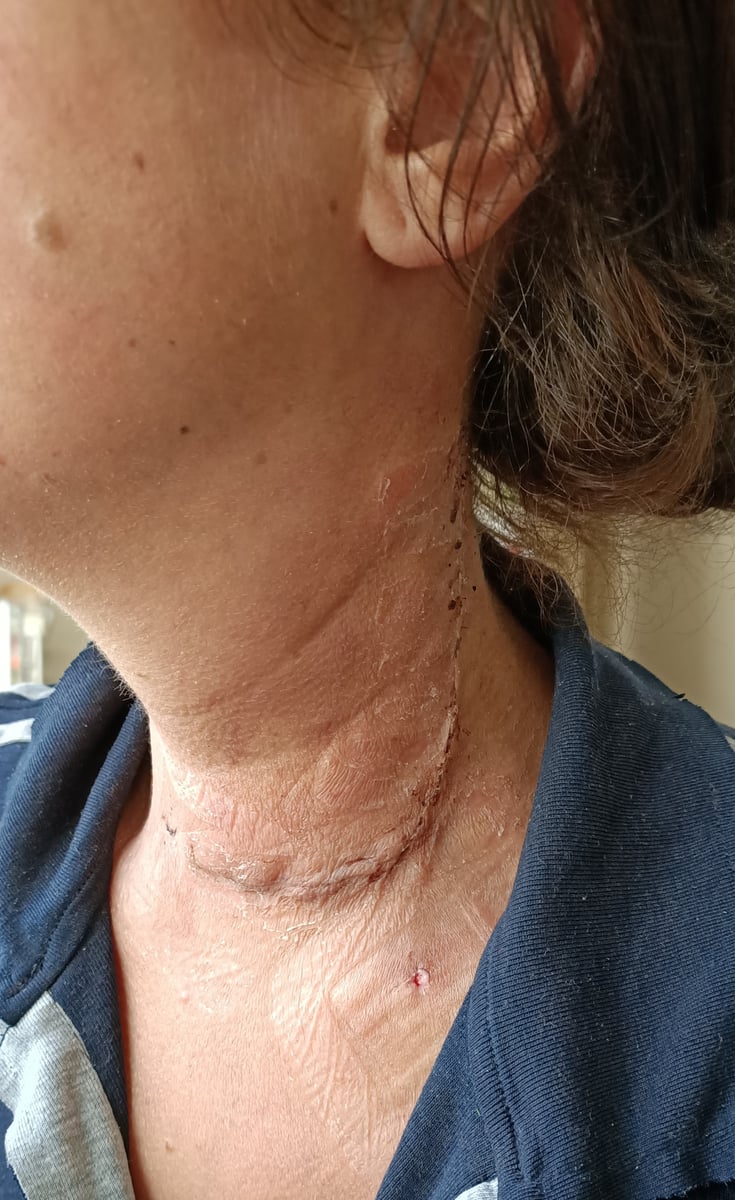 Image of woman's neck with 13cm scar after surgery to remove thyroid cancer.