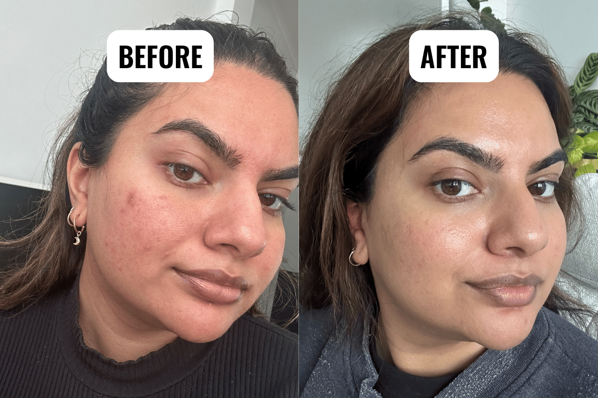 Before and after selfies of the BioRe peel.