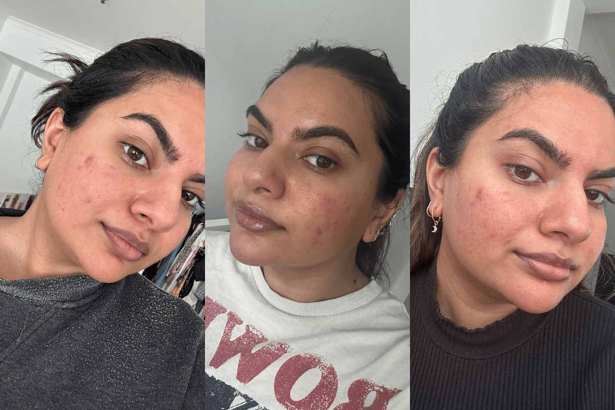 3 selfies showing my skin before the BioRePeel.