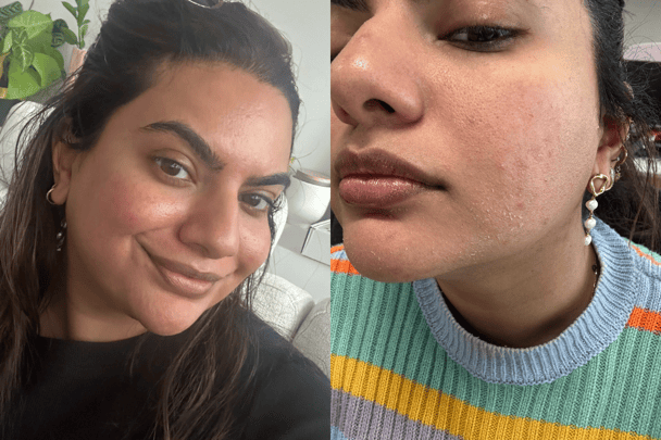 Selfies of my skin immediately after VS a few days after each session.