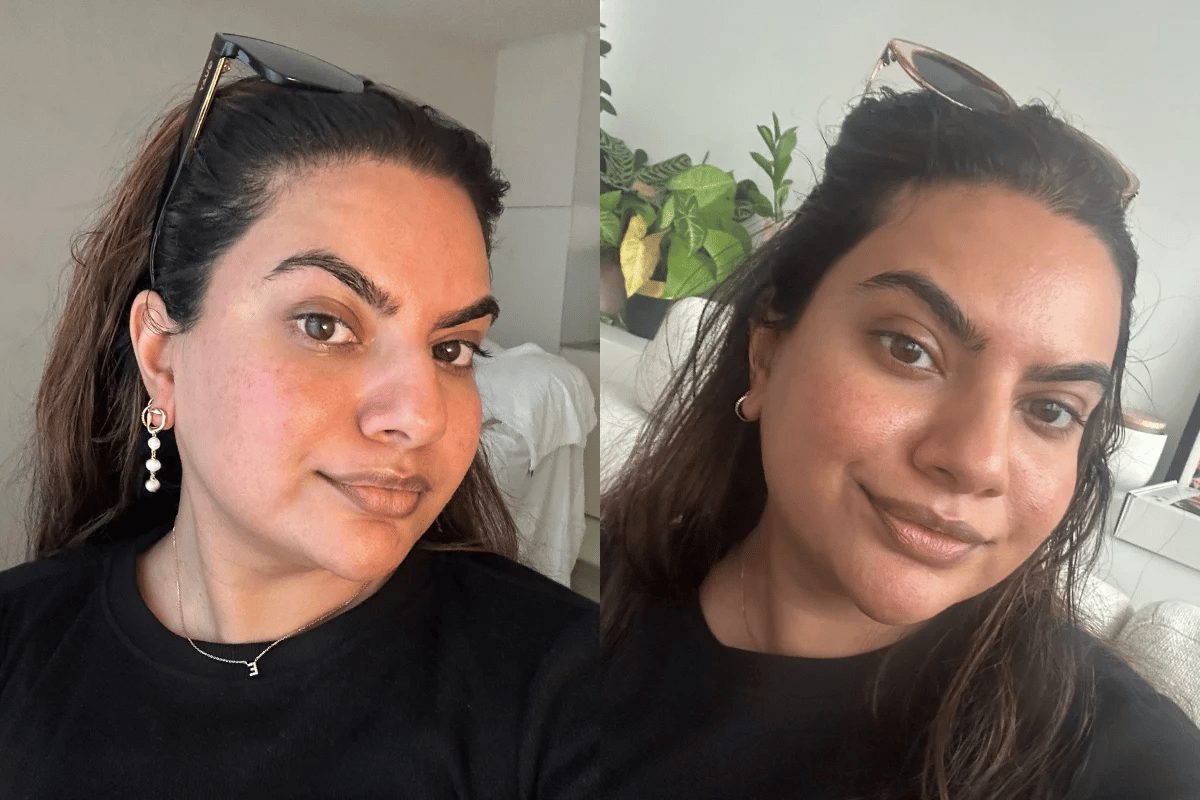 two selfies showing skin after the treatment.