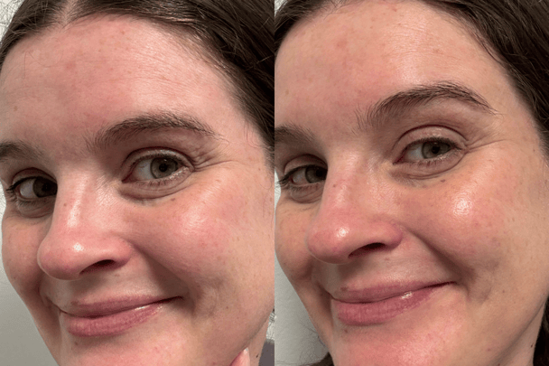 Before and after using Medik8 Liquid Peptides Advanced MP.