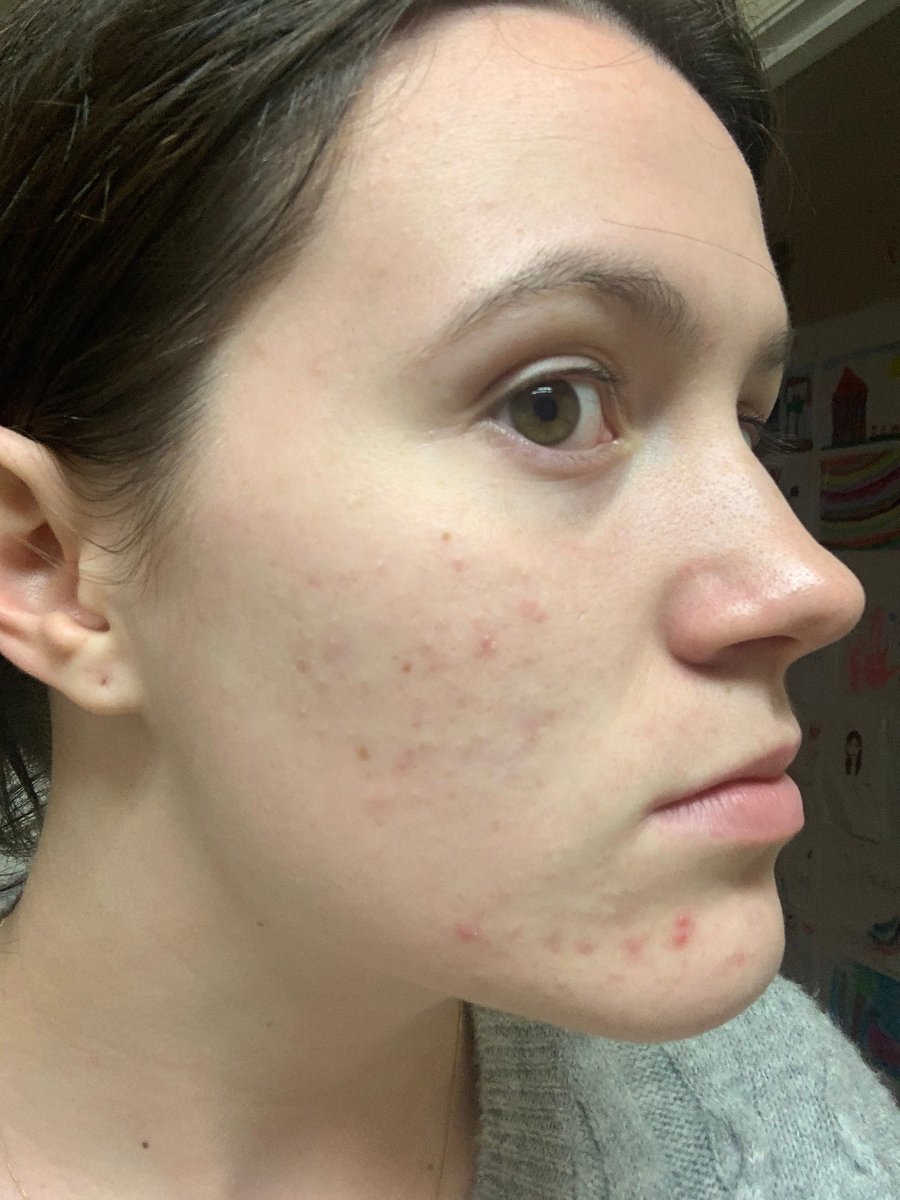 Image of Acne on Face.