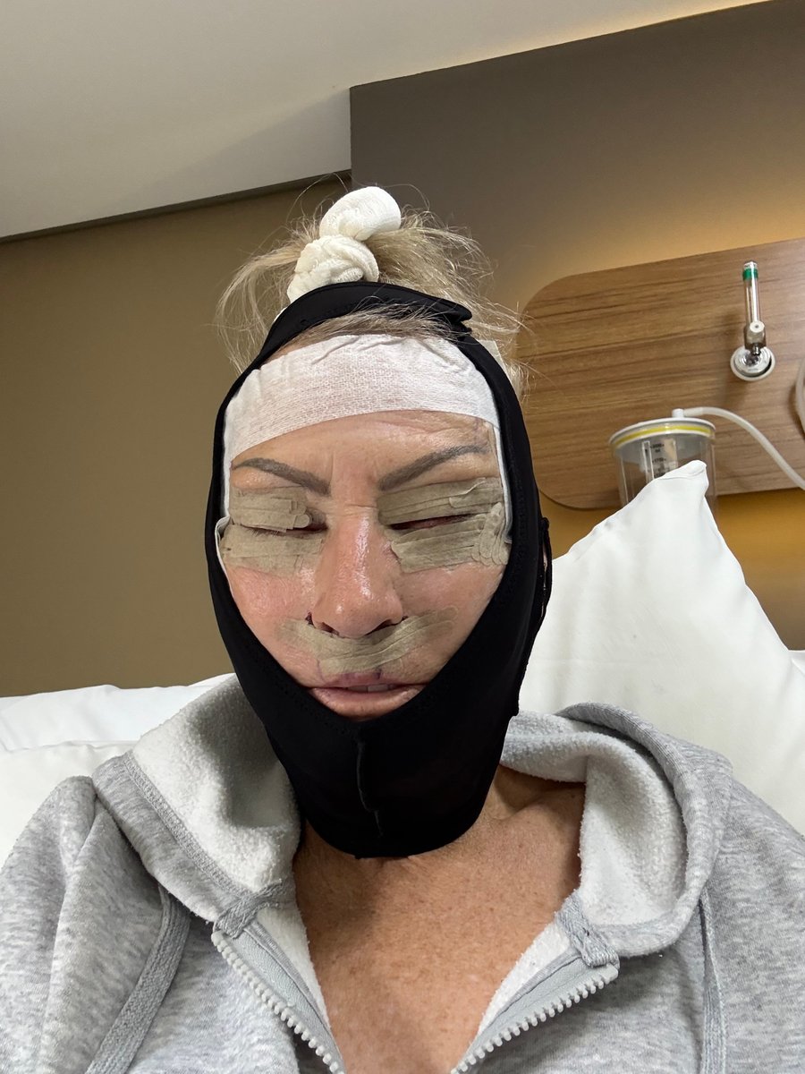 dalene-face-lift-turkey-after
