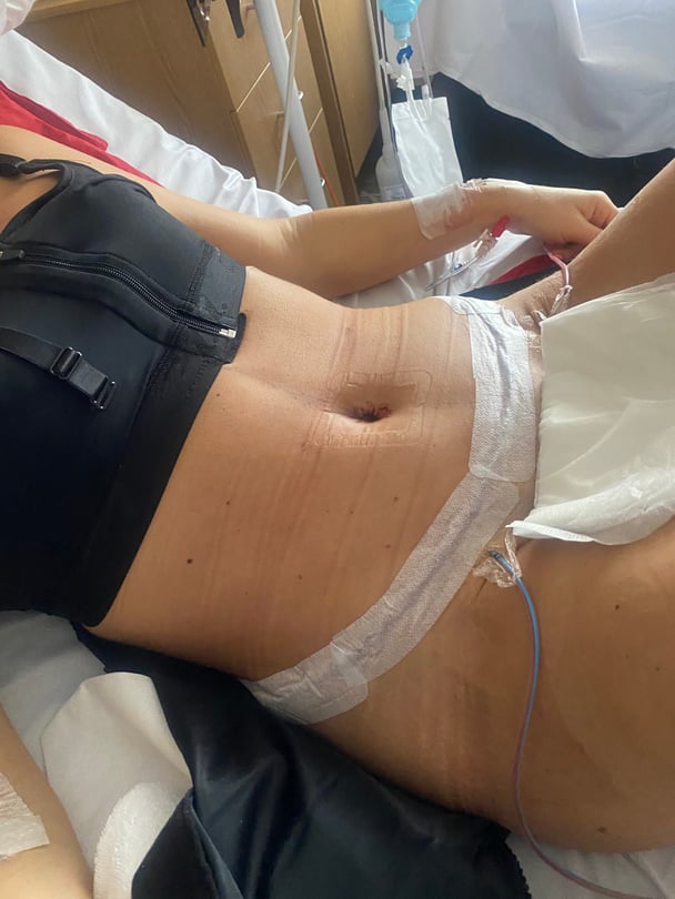 body after skin removal surgey