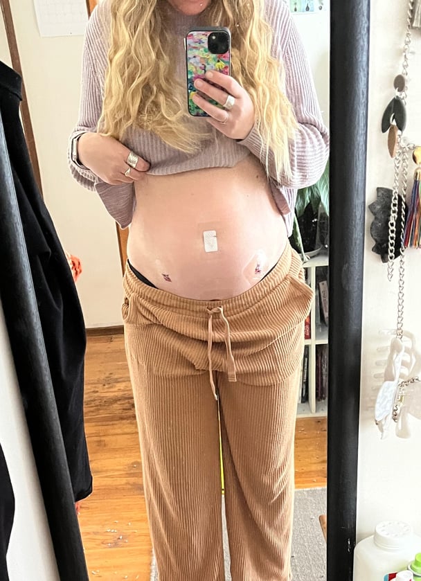 woman-belly-keyhole-surgery-incisions