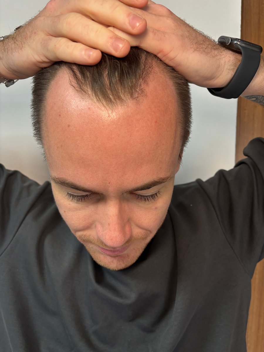 garett-hair-transplant-before