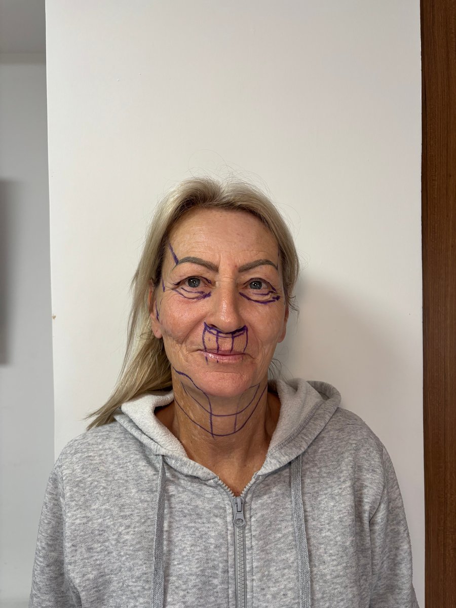 dalene-face-lift-turkey-before