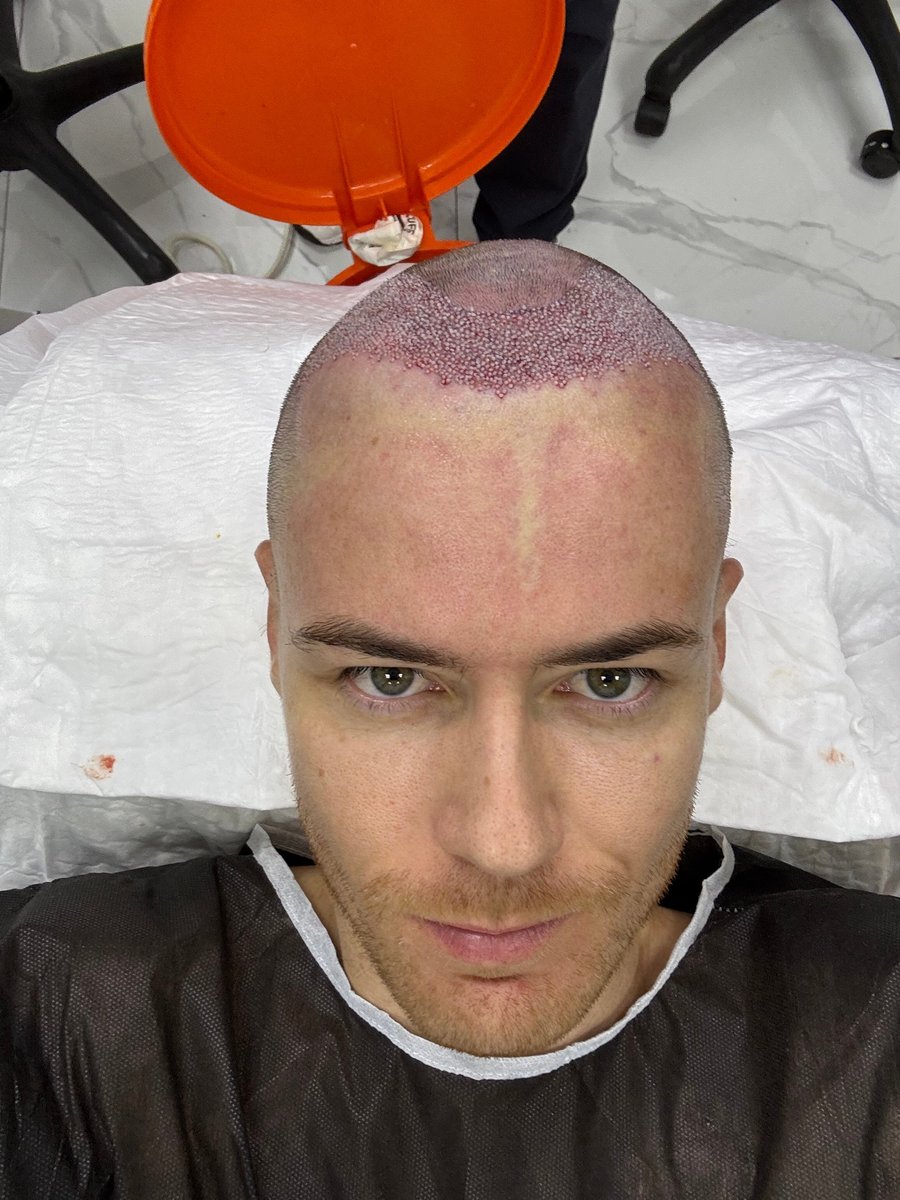 garett-hair-transplant-during-turkey