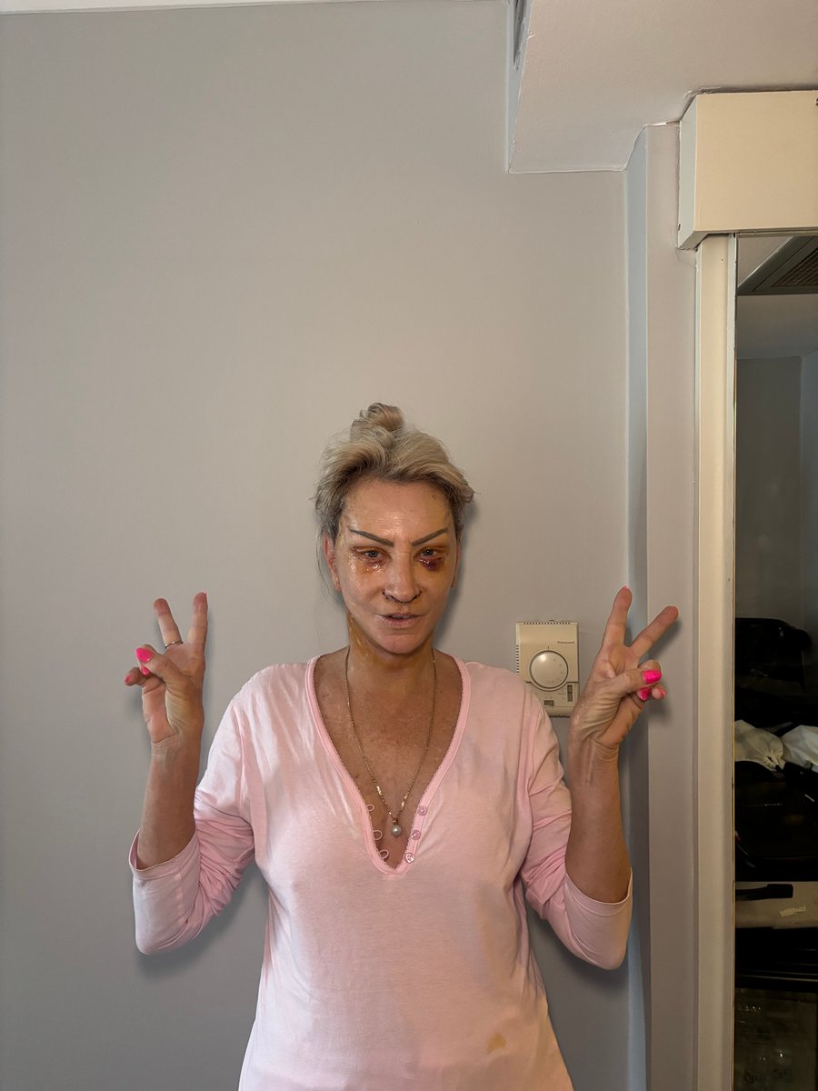 dalene-face-lift-turkey