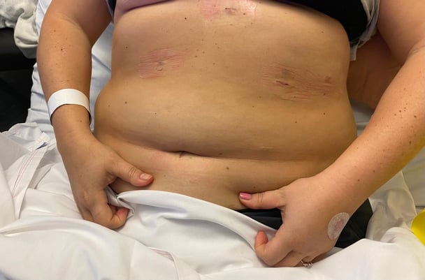 gastric sleeve surgery procedure