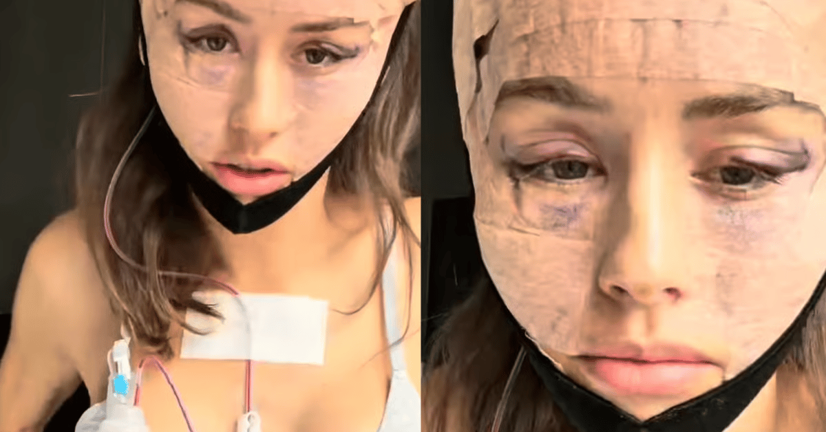 Ruby got a facelift at 33. It was more graphic than she realised.