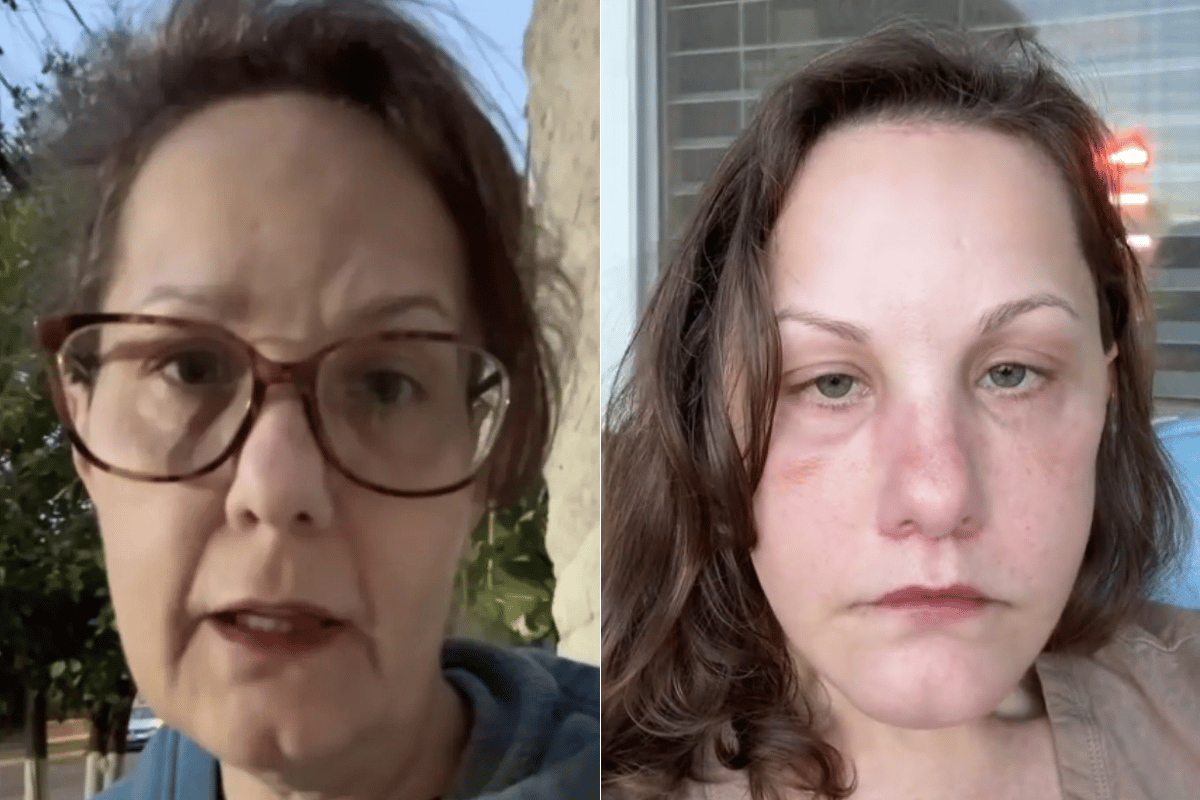 A side by side of a 50-year-old woman after plastic surgery.