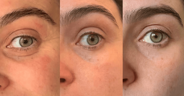 Before and after images of Erin Docherty's eye area after trialling The Ordinary's new PDR eye cream.