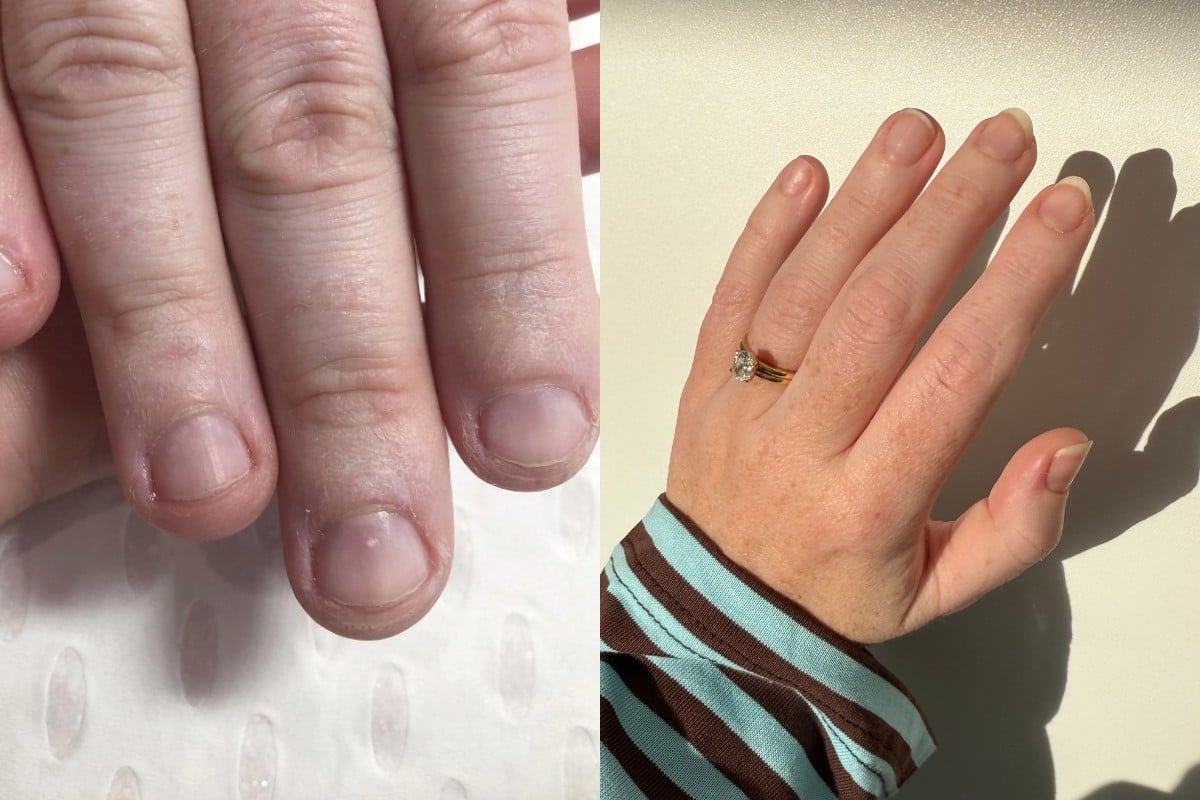 amy nail biting before and after