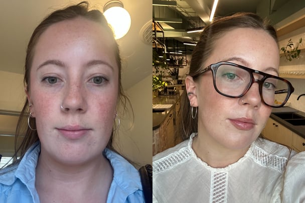 Split image of Lucy with lifeless dry skin vs. hydrated skin.