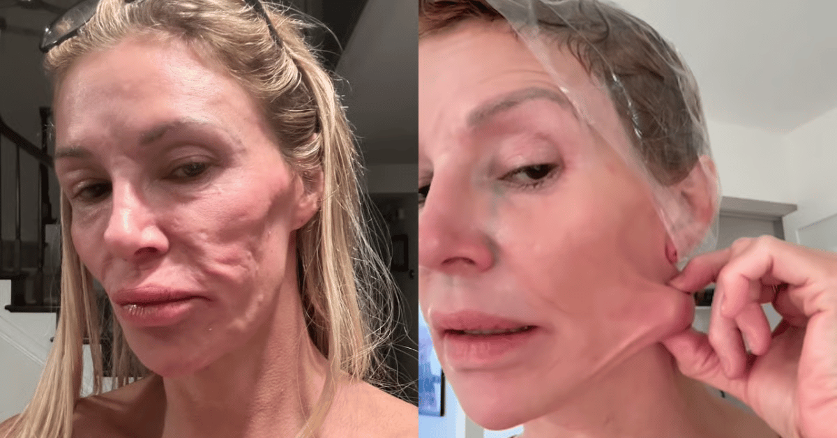 Brandi Glanville's facial condition has derailed her life. She finally has a diagnosis.