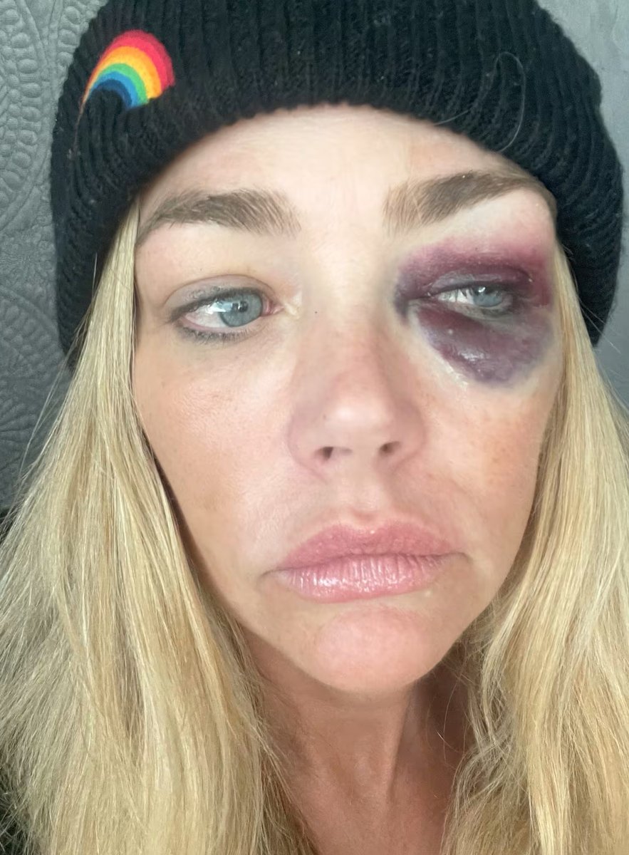A photo from the court filing shows Denise Richards with a bruised eye.
