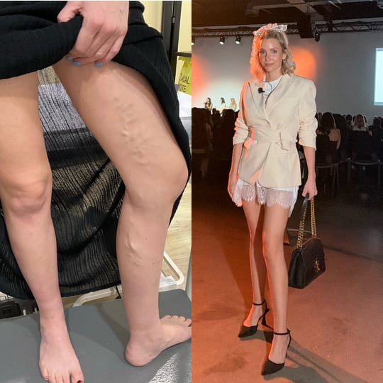 'I spent $6.5k on my leg, and it's made me infinitely more confident.'