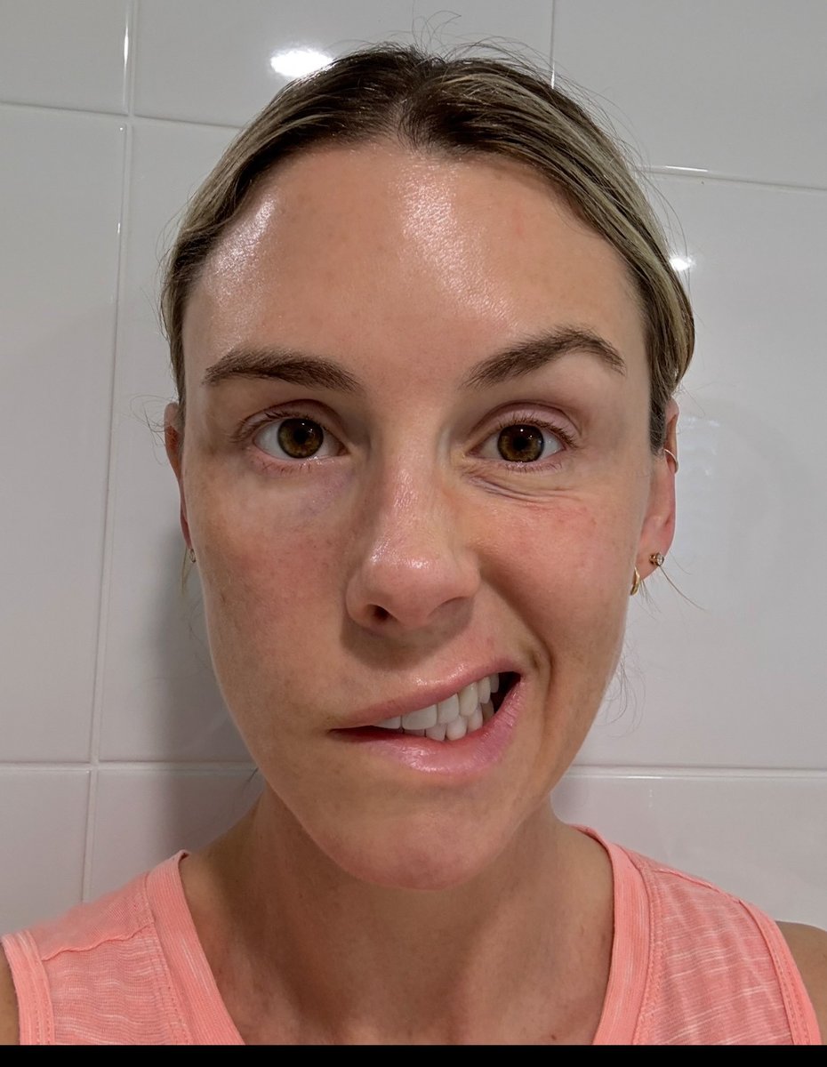 Laura Smith's face frozen from Ramsay Hunt Syndrome.